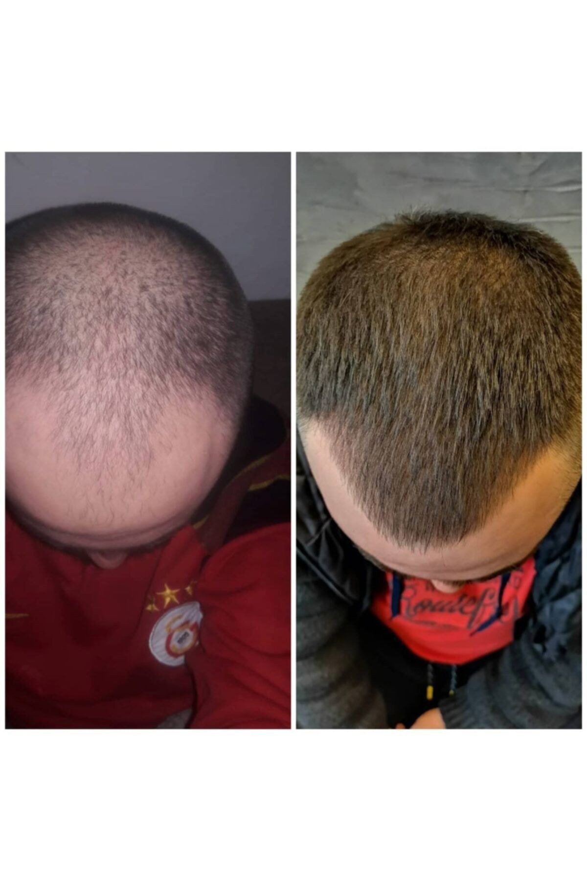 rex hair kozmetik unisex rex hair sac cikaran serum fiyati yorumlari trendyol