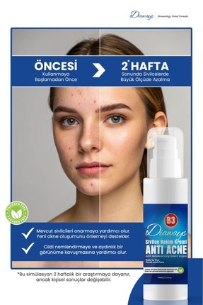 Sîvîlce ve Âkne Karşıtı,Sivilceye ve Akneye karşı kurutucu önleyici cilt yenileyici Kremi Image 0
