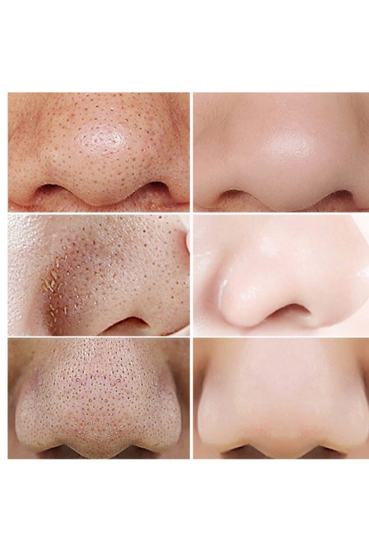 LANBENA Siyah Nokta Maske+ Gözenek Küçültücü Serum Kiti