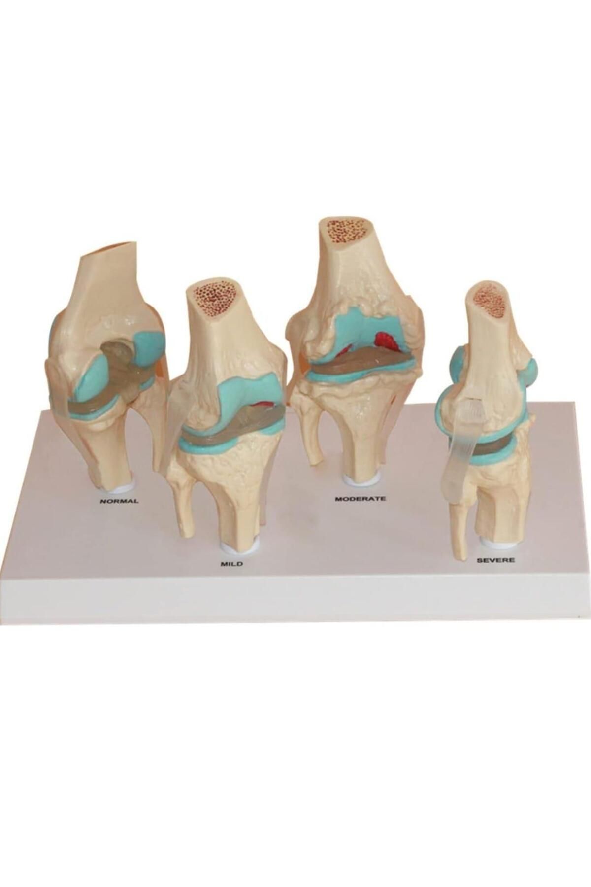 barishan medikal Diz Eklem Modeli İnsan Vücudu Anatomisi 4 Aşamalı Maket Seti Osteoartrit Diz Eklemi