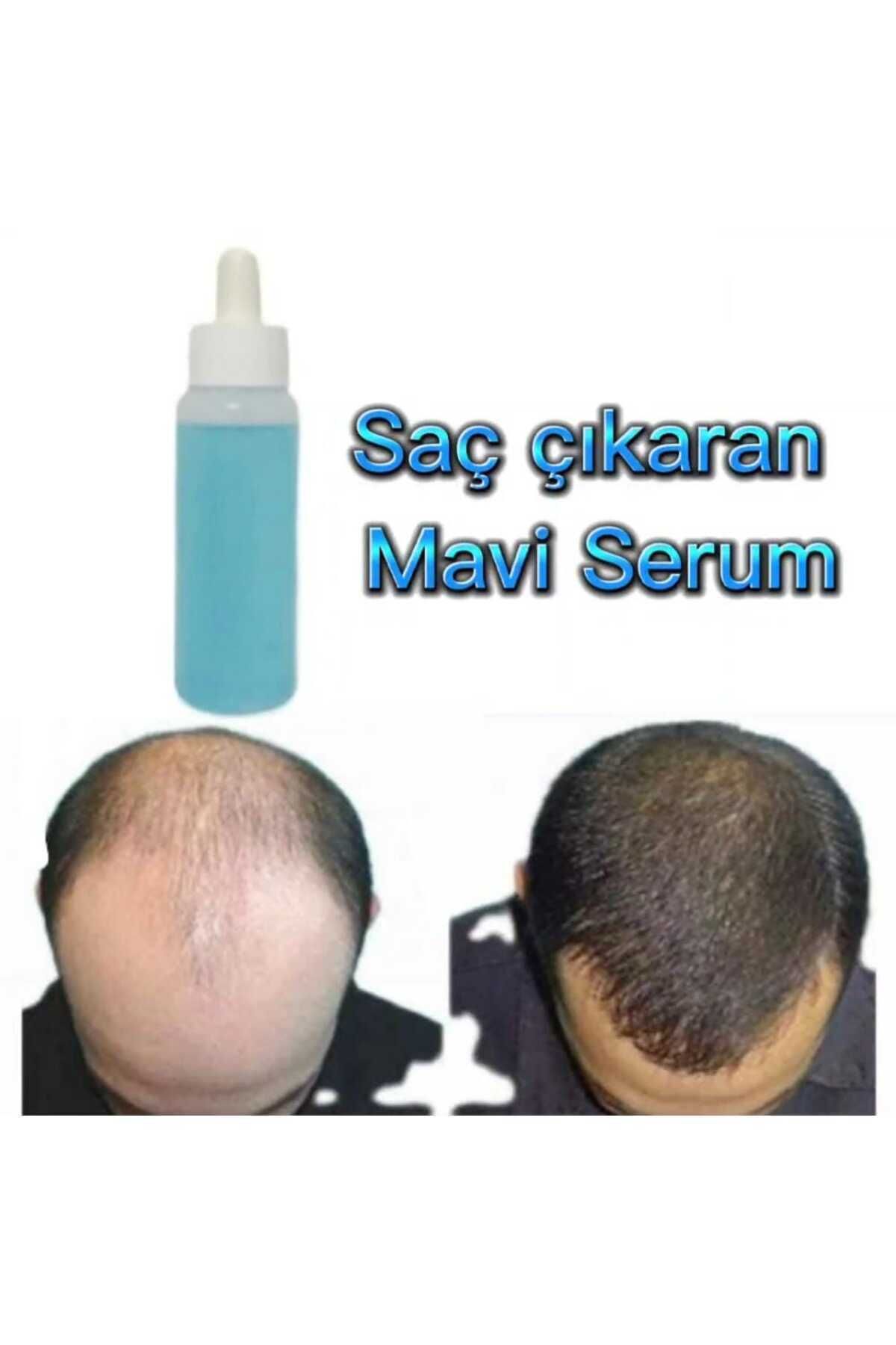 mavi serum 1 Adet Mavi Serum- Mavi Saç Bakım Serumu- Saç Çıkaran Losyon- Saç Dökülmesini Engeller Saç Çıkarıcı