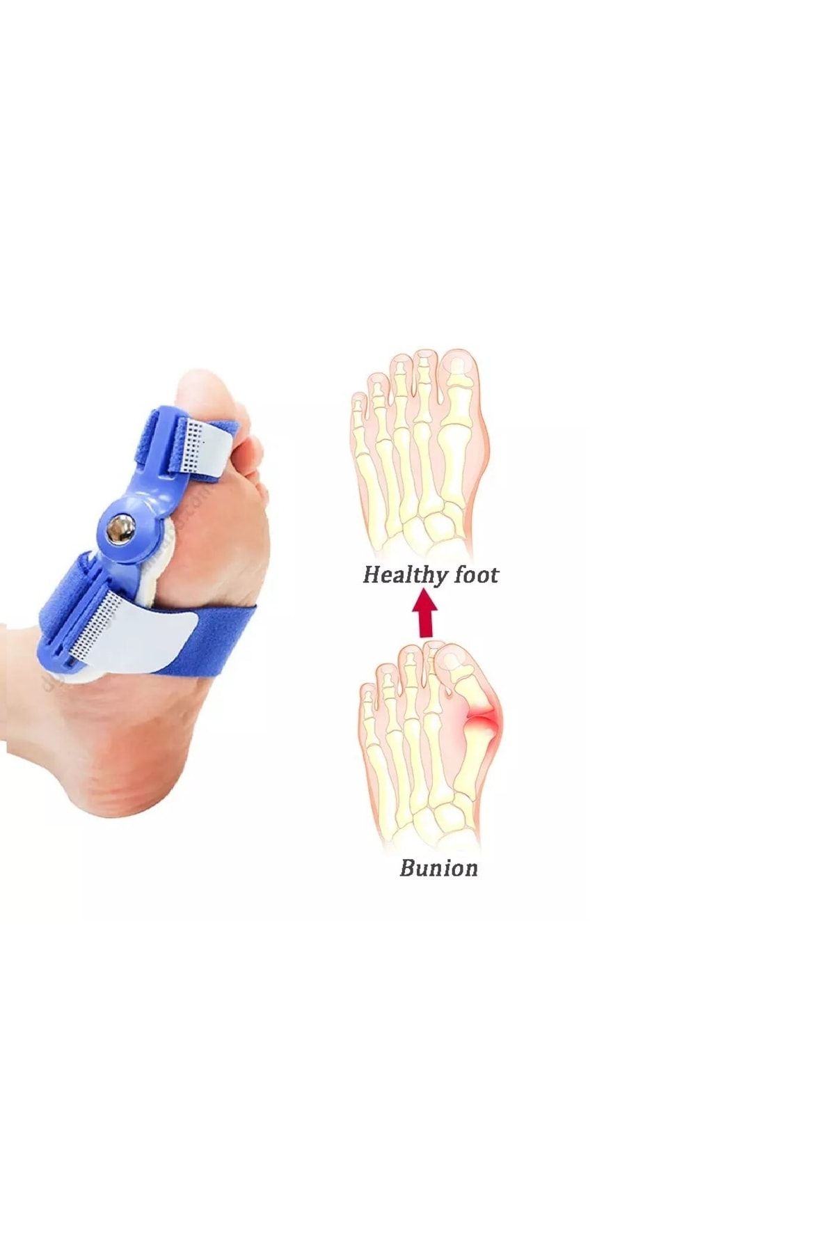 başarı ortopedi 2 Adet Ayak Baş Parmak Parmağı Kemik Kemiği Çıkıntısı Için Aparat Atel Halluks Valgus Bunyon