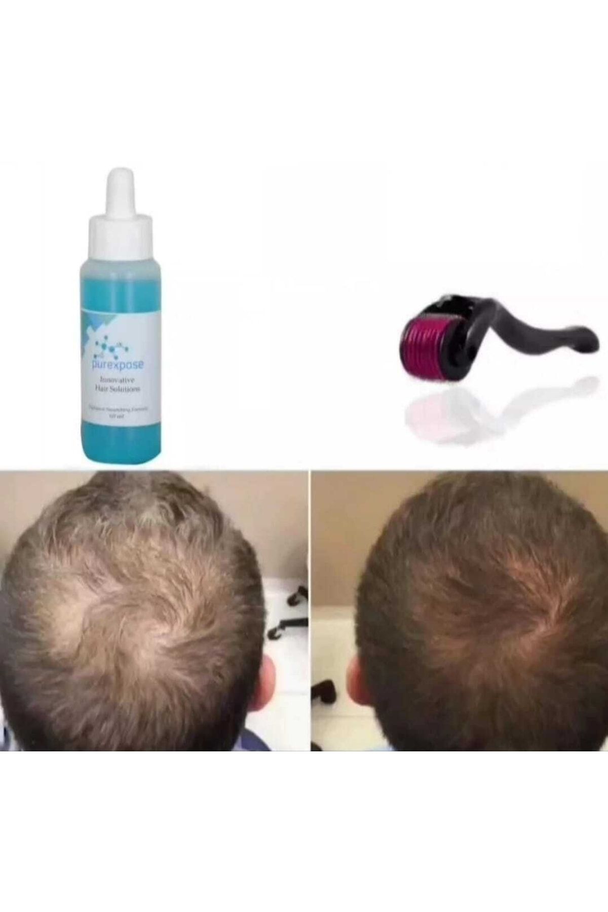 Purexpose Saç Serumu Saç Çıkarmaya Yardımcı Saç Besleyici Saç Gürleştirici Saç Losyon 1adet 1 Dermaroller
