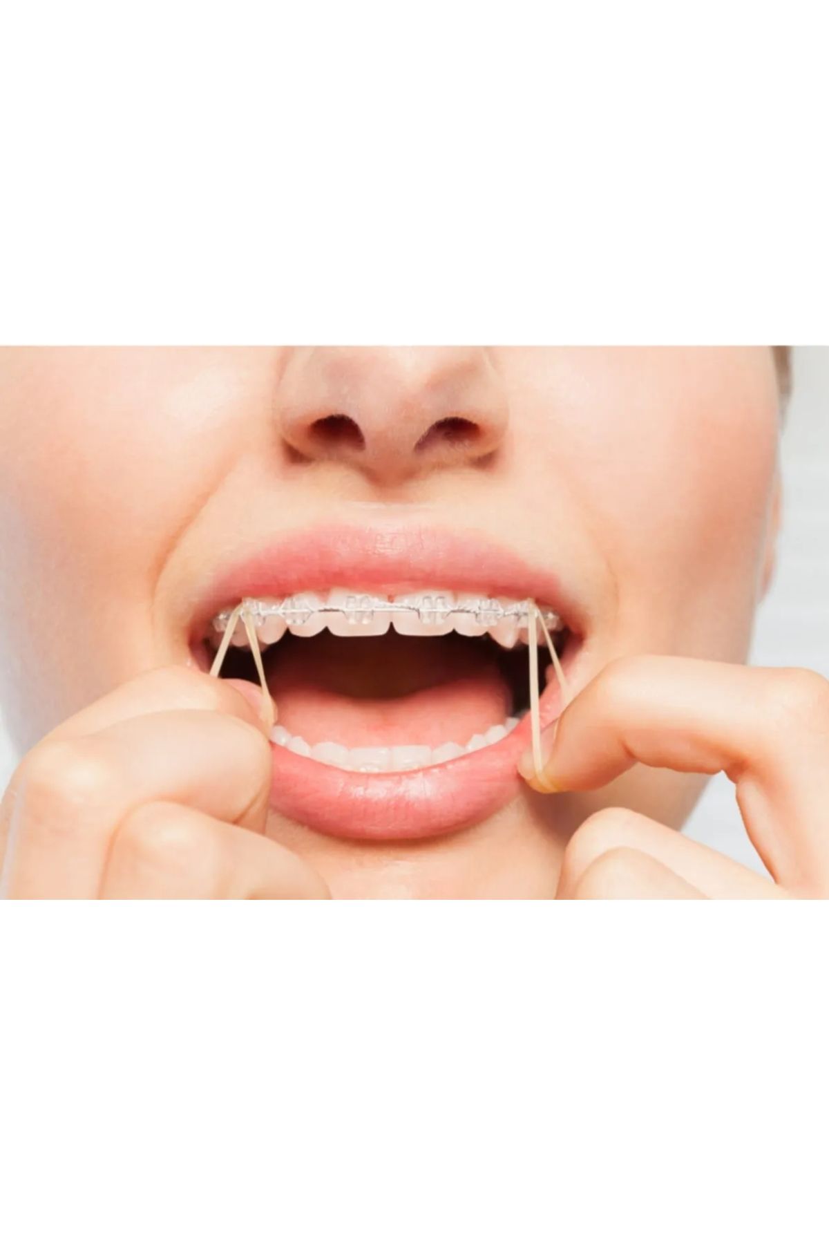 dehaberk Ağıziçi Ortodontik Elastik Rondel 1/4 Medium