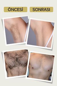 Karınca Yumurtası Yağlı Tüy Azaltıcı Inceltici Etkili 4 'lü Tüy Dökücü Krem Seti (UNİSEX) ürün fotoğrafı