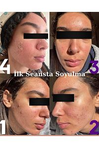 Yosun Peeling Yüz Peelingi Cilt Bakımı Yosun Maskesi Cilt Soyucu Leke Akne Sivilce 5 Kullanımlık ürün fotoğrafı