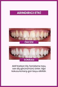 Diş Beyazlatma Seti | Aktif Karbonlu | Çay, Kahve ve Sigara Lekesi Karşıtı | Plak Önleyici ürün fotoğrafı