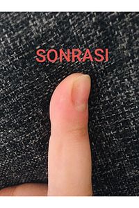 Nasırderm Nasır Sökücü ürün fotoğrafı