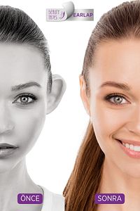 Earlap Max Hold Kozmetik Kepçe Kulak Düzeltici Bant, Kepçe Kulak Bandı, Kulak Bandı ürün fotoğrafı