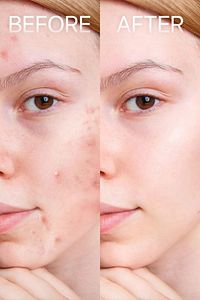 Sivilce Giderici Akne Ve Siyah Nokta Giderici Krem 50 ml ürün fotoğrafı