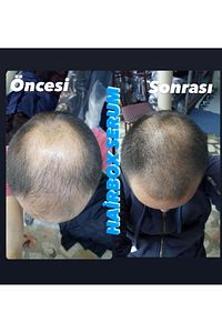 Erkek Saç Çıkarıcı Serum, Saç Çıkaran Serum , Saç Gürleştirici ( 1 Adet ) ürün fotoğrafı