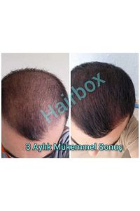 Erkek Saç Çıkarıcı Serum, Saç Çıkaran Serum , Saç Gürleştirici ( 1 Adet ) ürün fotoğrafı