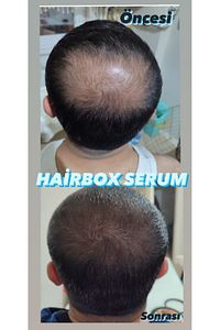 Erkek Saç Çıkarıcı Serum, Saç Çıkaran Serum , Saç Gürleştirici ( 1 Adet ) ürün fotoğrafı