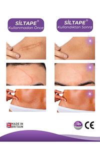 Siltape Soft Silikon Bant - Yanık Sezaryen Dikiş Izi Keloid Ameliyat Izi Giderici 2cmx3mt ürün fotoğrafı