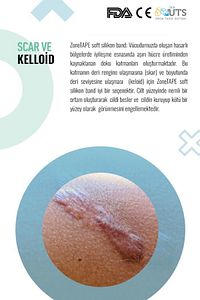 Soft Silikon Bant - 2cmx3mt- Estetik-skar-keloid-sezaryen-dikiş-karın/kol/bacak Germe-ben Aldırma ürün fotoğrafı