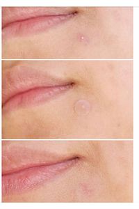 Ceuticals Original Pimple Patch 36 Patch - Akne Ve Sivilce Bandı ürün fotoğrafı