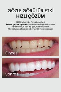 Diş Beyazlatma Seti | Aktif Karbonlu | Çay, Kahve ve Sigara Lekesi Karşıtı | Plak Önleyici ürün fotoğrafı