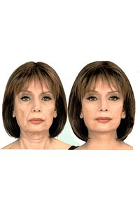 Yüz Gerdirme Bandı Kırışıklık Oluşumunu Engelleme Bandı Yüz Germe 5cm 5 Mt ürün fotoğrafı