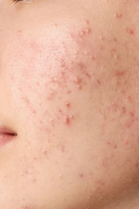پیلینگ صورت Leke Karşıtı Bakım serena beauty - کد 894769899