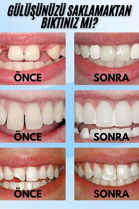مراقبت دندان مصنوعی Moldable - کد 874350125
