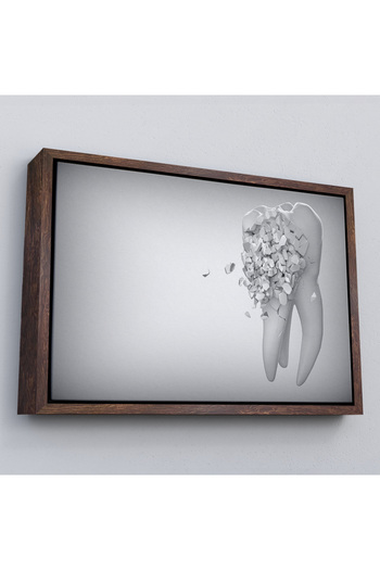 indispensablely Framed Dental Clinic Wall Chart, Decayed Teeth, Dentist Chart-5372