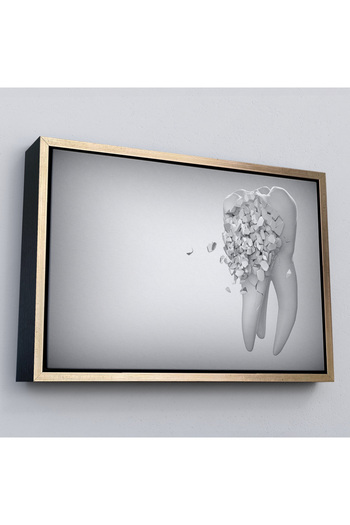 indispensablely Framed Dental Clinic Wall Chart, Decayed Teeth, Dentist Chart-5372