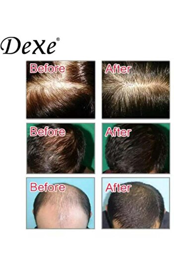 Dexe Anti-hair Loss Lotion Spray 120ml