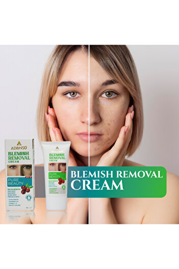 ALVANSO Blemish Removal Cream 75 ML