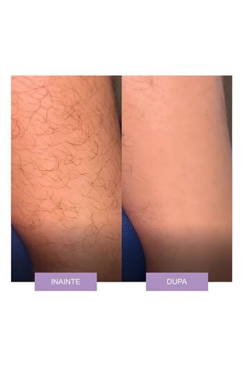 NEO Epilator cu Cristale, pentru Epilarea de Lunga Durata, Mov,