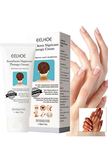EELHOE Acanthosis Nigricans Therapy Cream- with Lactic Acid ,Dermatologist Tested Retinol Cream , Hy