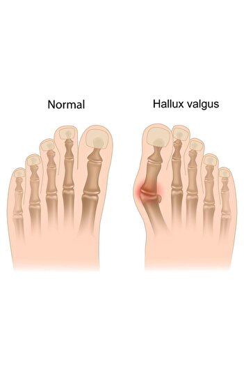 Supportline Medical Orthopedic Protective Hallux Valgus Shoes (PAIR) Hallux Valgus - Intermed