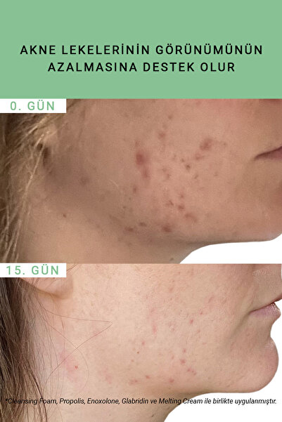 Etat Pur Pure Active Propolis Akne Karşıtı Antienflamatuar & Yatıştırıcı Etkili Konsantre Bakım Serumu 15ML