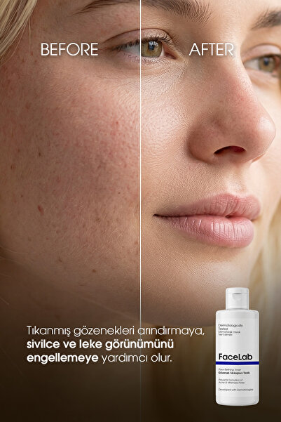 FaceLab Salisilik Asit (BHA) Tonik 200 ml – Akne & Karşıtı, Gözenek Sıkılaştırıcı Arındırıcı Tonik | Yüz Toniği | Sebum Dengeleyici Tonik | Siyah Nokta Toniği | Cilt Toniği