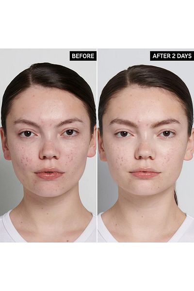 THE INKEY LIST CAME COSMETICS - علاج حب الشباب بحمض السكسينيك - علاج مضاد للعيوب 15 مل