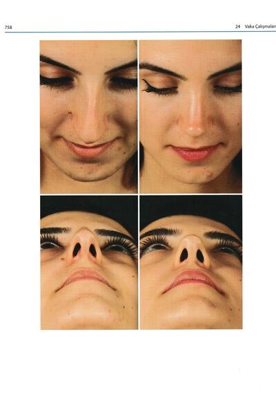 Avrupa Tıp Kitabevi Estetik Septorinoplasti