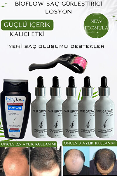 BioFlow 5 قطع لوشن لإزالة الشعر وتجعيده - محلول طبيعي للصلع