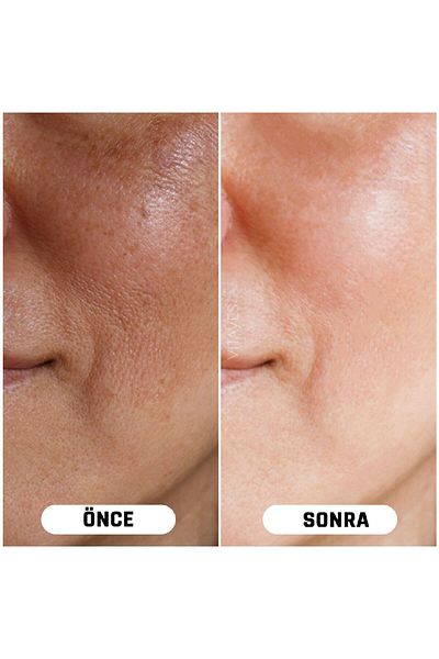 VITAYES Vitamin C 10% and Hyaluronic Acid Brightening Skin Tone Equalizing Skin Serum Dual Advantage Set