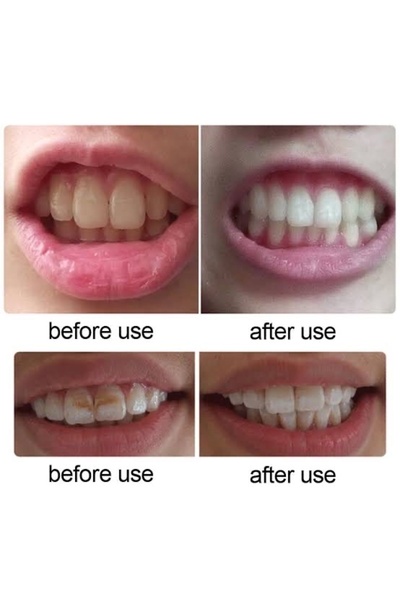 GELLO 2'li Diş Beyazlatıcı Jel (2 Adet)