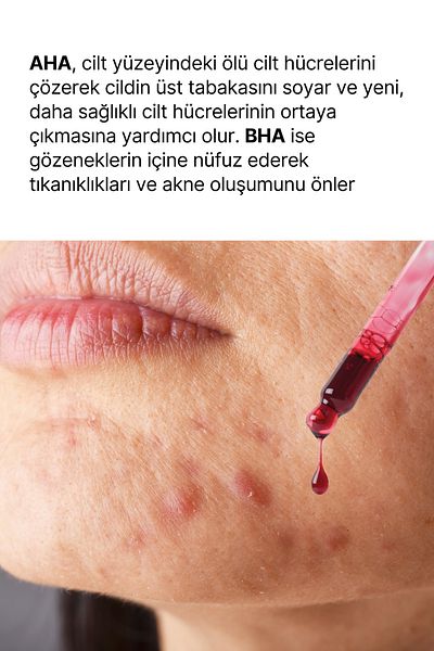 anocin AHA 20% + BHA 2% Revitalizing & Skin Tone Equalizing Red Peeling Skin Serum