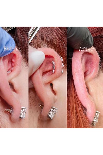 Karınca Piercing Piercing Stopper Piercing Keloid Preventive Bump Ant Tattoo (2 Pcs)