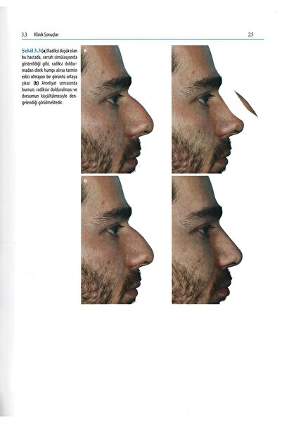 Avrupa Tıp Kitabevi Rinoplasti Atlası