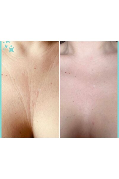 biosmile Cushioned Clink Preventive Between Decollete and Breast