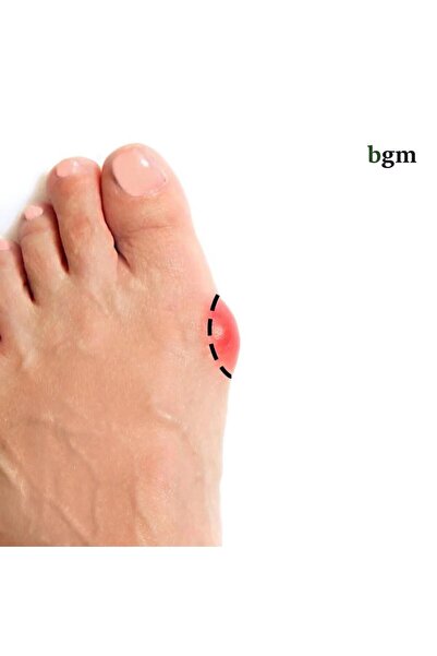 bgm Gece Ateli Bandajı Halluks Valgus Gece Bandajı – Yüksek Kalite Halluks Tedavisi