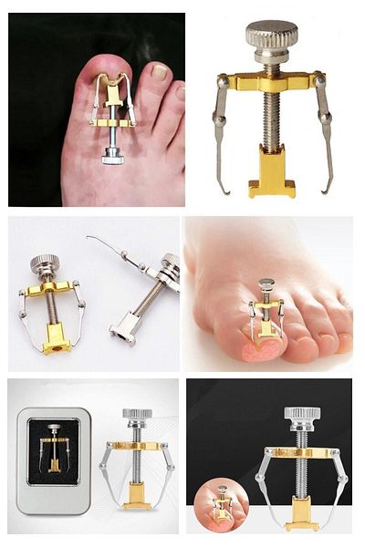DEMİRHAN İTHALAT Ingrown Nail Correction Device - Ingrown Nail and Ingrown Nail Correction Tool