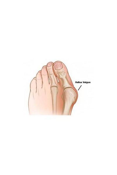 Case Hallux Valgus Night Splint Left Toe Bone Support Splint Splinti By Sungur Medical