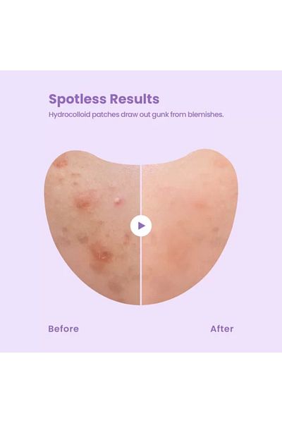 Glam Up Spotless Hydrocolloid Pimple Patch XL Band (12count)
