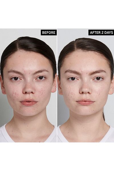 THE INKEY LIST 15 Ml Succinic Acid - Pileji Treatment