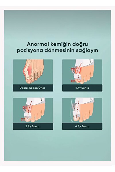 Mi-ÇA HOME Ayak Baş Parmak Düzeltici Aparat Atel / Ayak Kemik Eğriliği Bunyon Gece Ateli Halluk Valgus 1 Adet