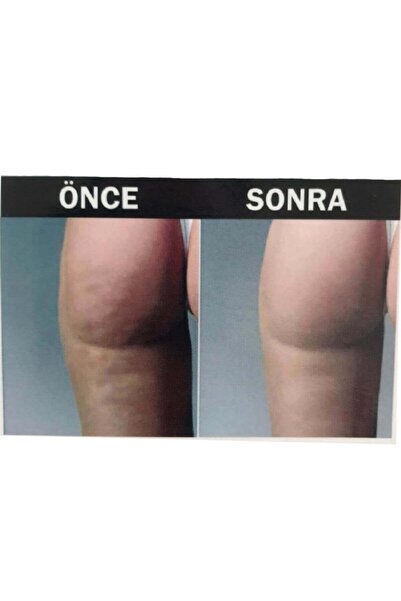 HEMA Women's Anti-cellulite Massage Seamless Corset