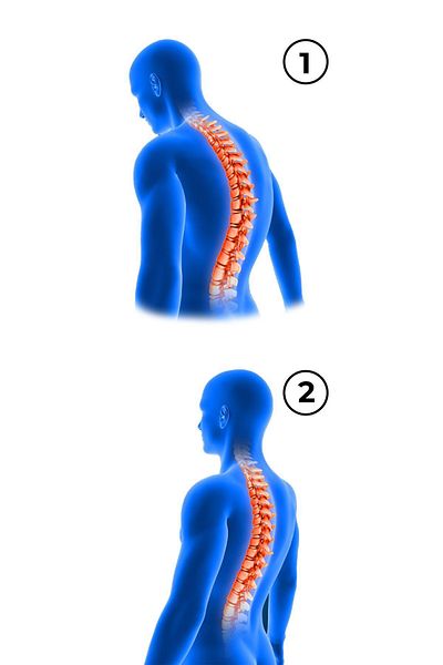 Flexy Medical Orthopedic Upright Posture Corset - Humpback, Back Shoulder Disorder
